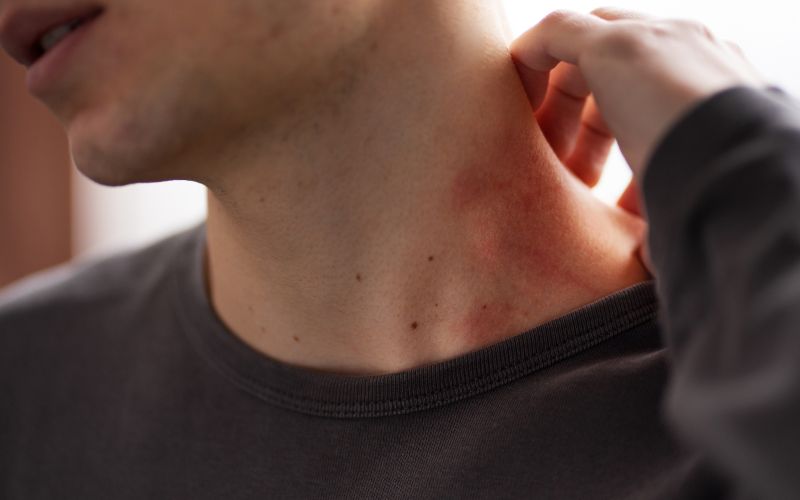 Biến chứng bệnh tiểu đường tuýp 2 gặp những vấn đề về da