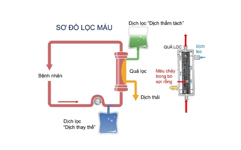 Sơ đồ lọc máu liên tục