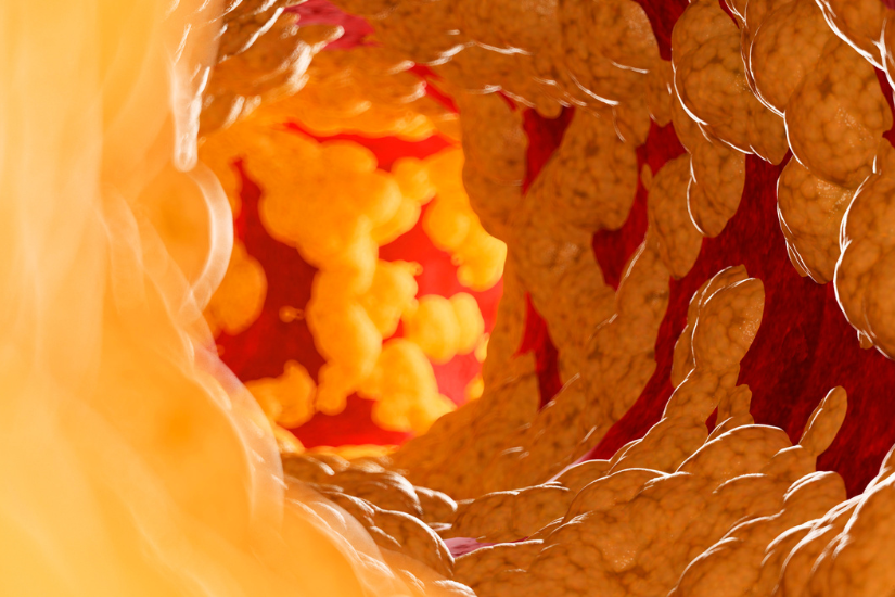 Lọc mỡ máu là gì? Lọc mỡ máu có tác dụng gì?