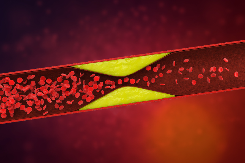 Lựa chọn cơ sở y tế uy tín để có chi phí lọc mỡ máu phù hợp