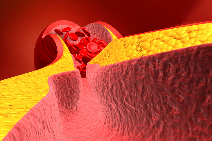 Một số lưu ý trong quá trình lọc mỡ máu