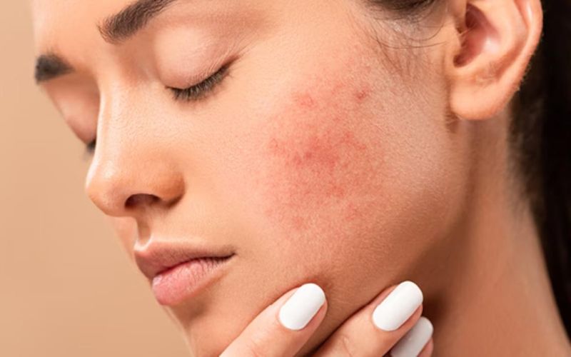 Công nghệ tế bào gốc còn có tác dụng tích cực trong việc hỗ trợ trị nám da, mụn và tàn nhang