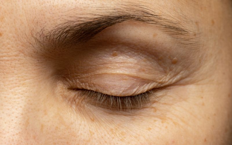 Nếp nhăn và vết chân chim là một trong những dấu hiệu rõ ràng nhất của lão hóa da