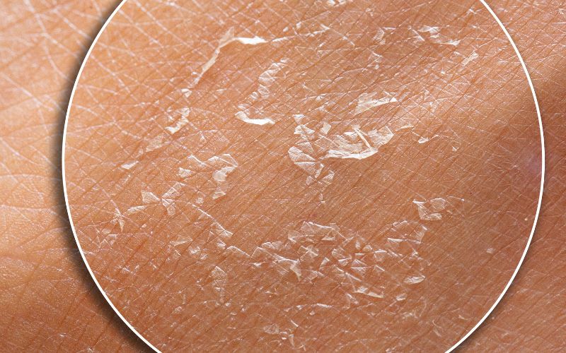 Một dấu hiệu lão hóa da rõ ràng khác chính là tình trạng da khô ráp