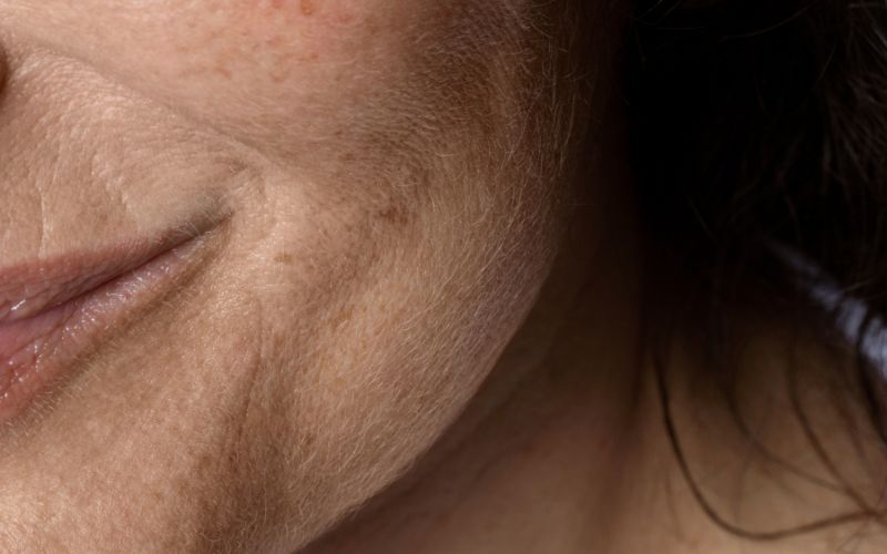 Dấu hiệu lão hoá da chúng ta dễ nhận thấy là sự chảy xệ của da