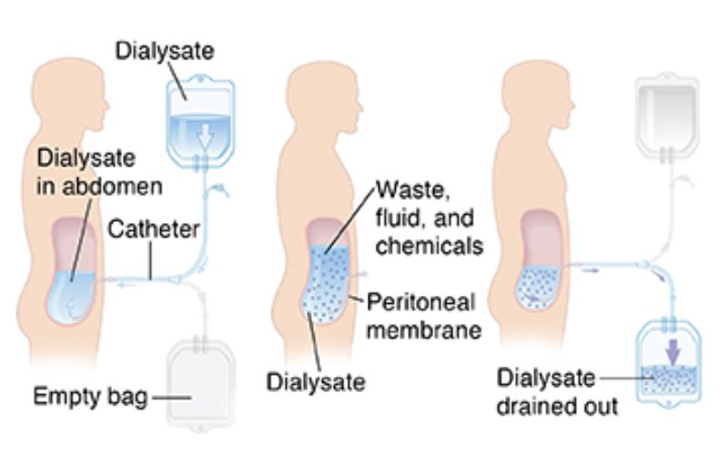 dieu-tri-loc-mau-suy-than-cap
