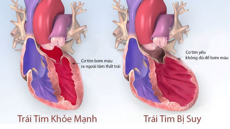 dieu-tri-loc-mau-tim-mach