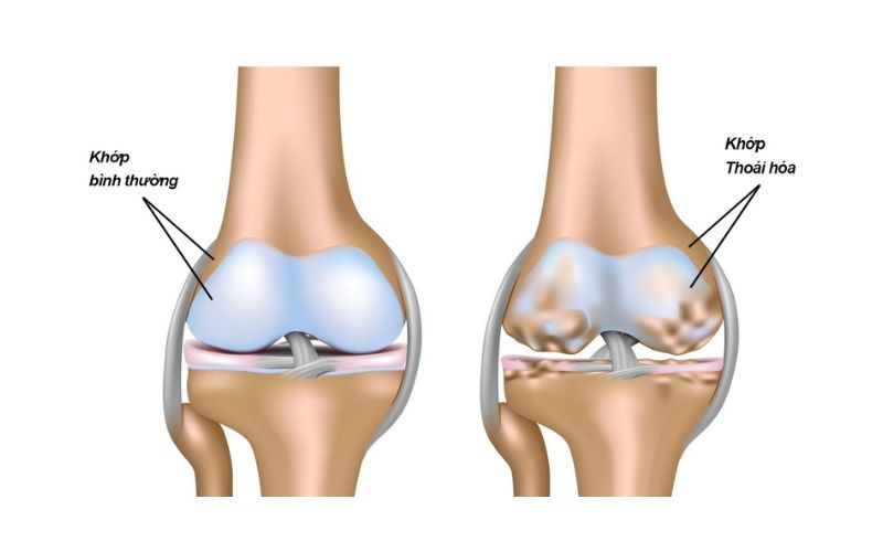 Thoái hóa khớp là quá trình lão hóa của sụn khớp, các tế bào ở khớp và các mô xung quanh khớp
