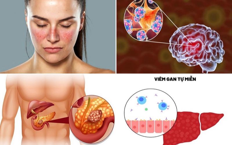 Bệnh tự nhiễm gia tặng mạnh sau đại dịch Covid 19