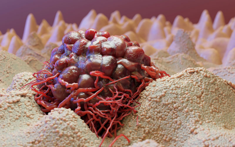 Vai trò của tế bào gốc trong điều trị ung thư vú