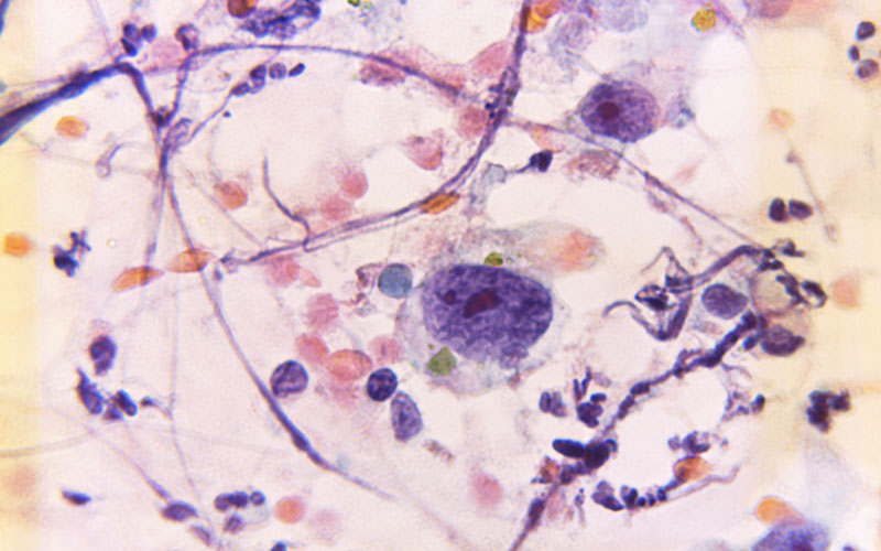 Một số ứng dụng của tế bào gốc trung mô sau khi điều trị ung thư vú