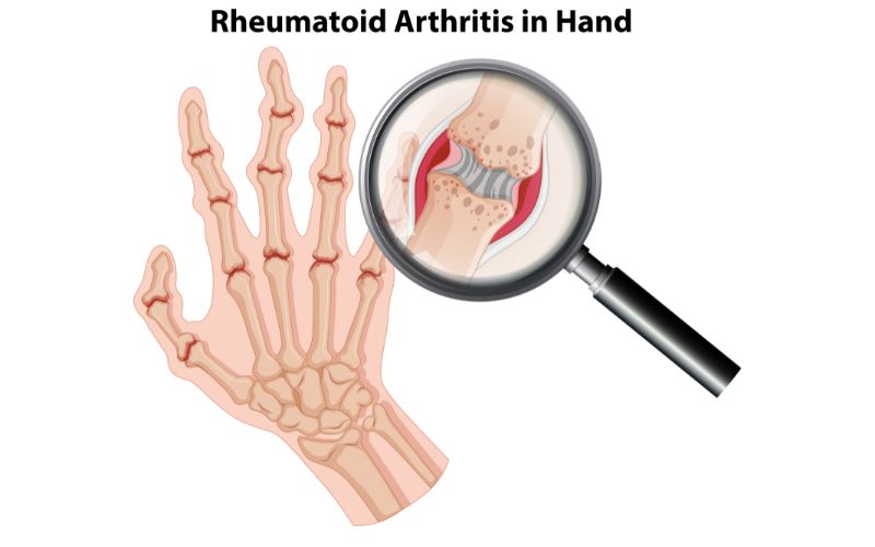 Nguyên nhân gây ra tình trạng viêm khớp dạng thấp