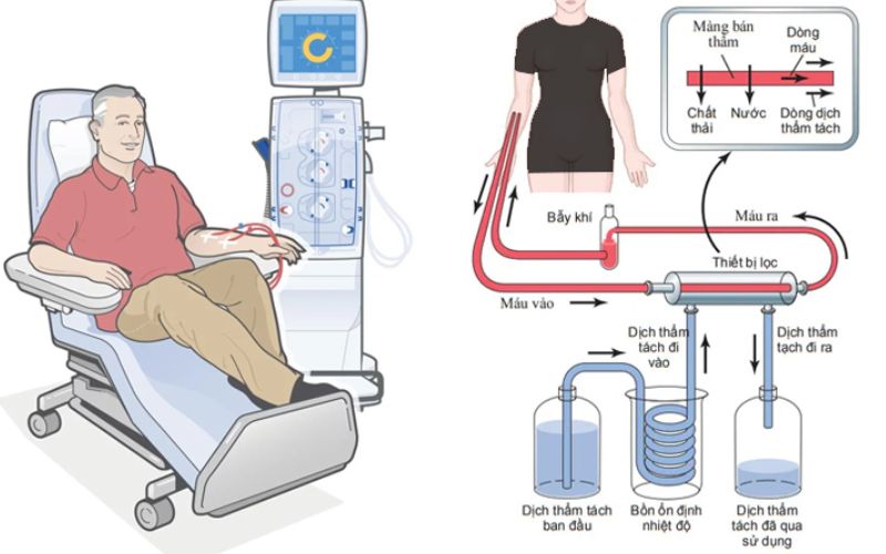 loc-mau-trong-dieu-tri-suy-than