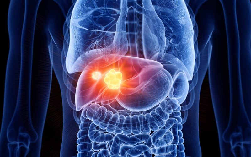 loc-mau-duong-tieu-hoa-cho-benh-nhan-suy-gan-do-ung-thu-gan