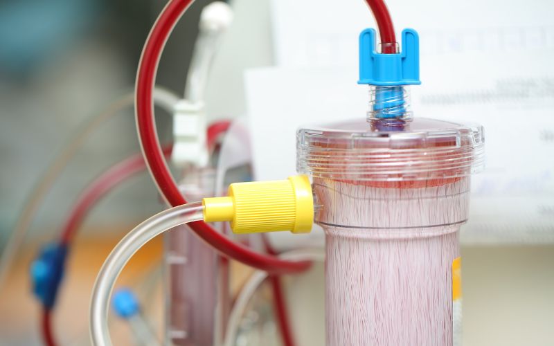 Lọc máu xấu cho người béo phì là gì?