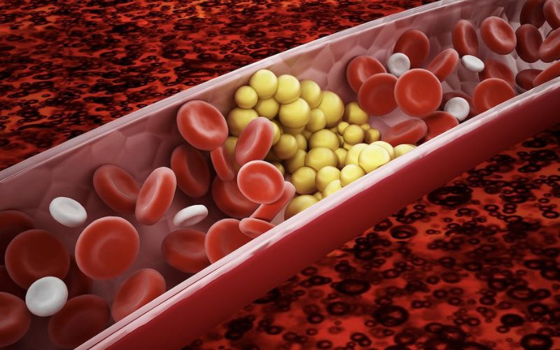 Tình trạng máu xấu và mỡ máu hiện nay