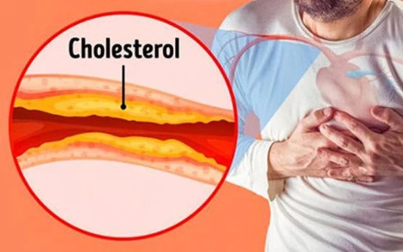 Phương pháp lọc máu xấu giảm mỡ máu này giúp cân bằng mức cholesterol trong cơ thể