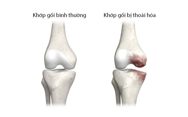 Khớp gối của người bình thường và khớp gối đã bị thoái hoá