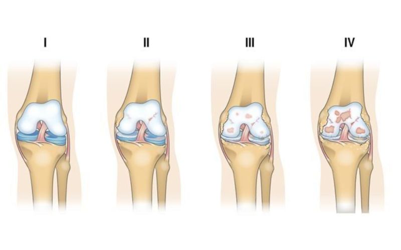 Các giai đoạn phát triển của bệnh thoái hoá khớp