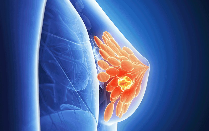 hoá da ngực bằng tế bào gốc