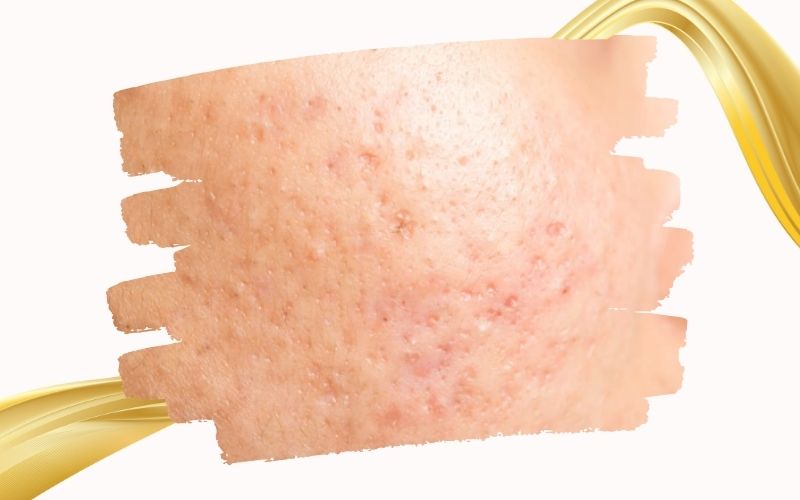 Trẻ hóa da mặt bằng tế bào gốc cho da mụn