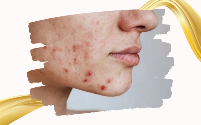 Trẻ hóa da mặt bằng tế bào gốc cho da mụn