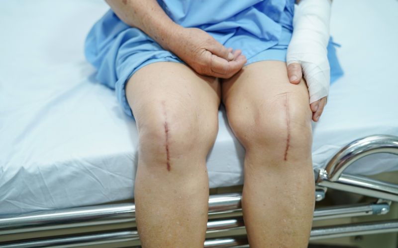 ưu điểm lớn của phương pháp trị viêm khớp bằng tế bào gốc là không để lại sẹo xấu