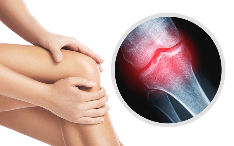 Nguyên nhân tại khớp gây nên viêm khớp như sụn khớp hao mòn, gãy xương, bệnh gút