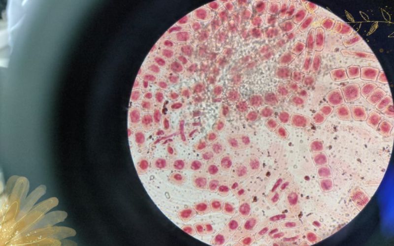 Hỗ trợ viêm khớp dạng thấp bằng tế bào gốc an toàn, hiệu quả