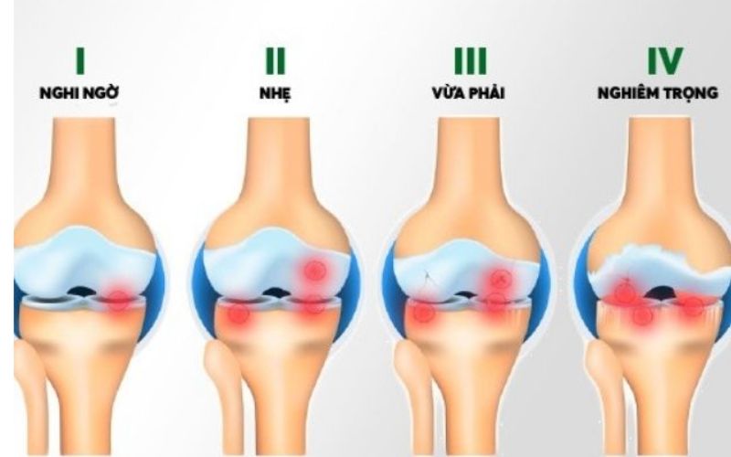 Các triệu chứng thoái hoá khớp gối ban đầu có thể khó nhận biết, nhưng khi bệnh tiến triển qua các giai đoạn