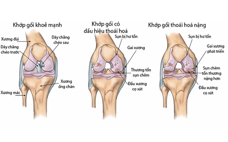 Viêm khớp gối là gì
